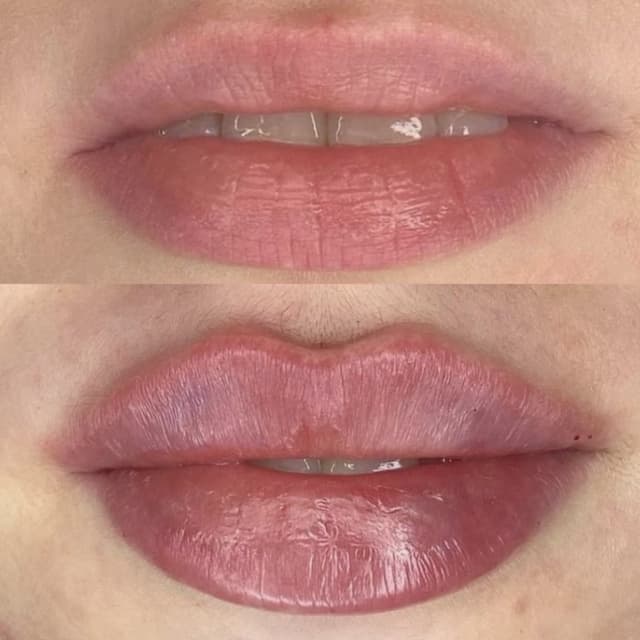 Lip Enhancement Experience at Arewa Essential Medspa in Mamaroneck, NY